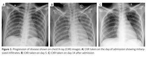 Figure from article: Opportunistic infection...